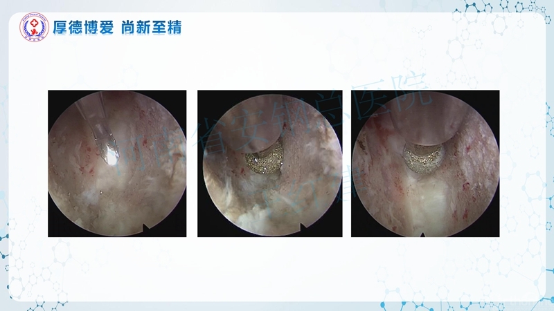 Endo-Assisted-ACDF技术流程与体会_52.jpg