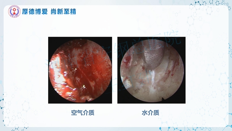 Endo-Assisted-ACDF技术流程与体会_51.jpg