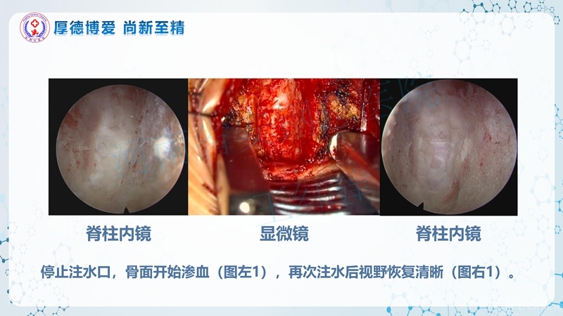 Endo-Assisted-ACDF技术流程与体会_53.jpg