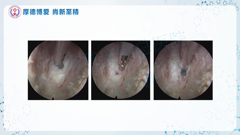 Endo-Assisted-ACDF技术流程与体会_54.jpg