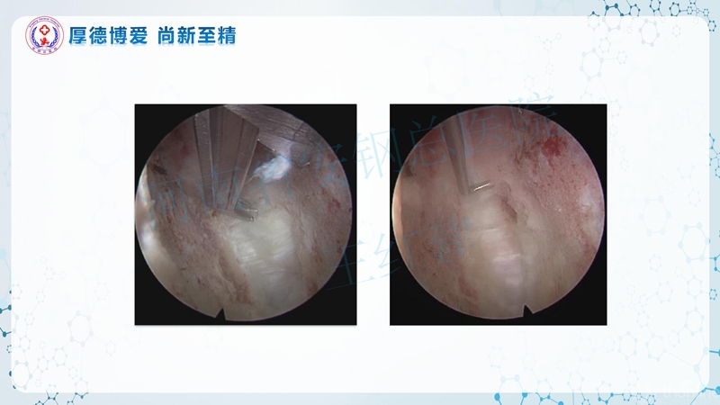 Endo-Assisted-ACDF技术流程与体会_55.jpg