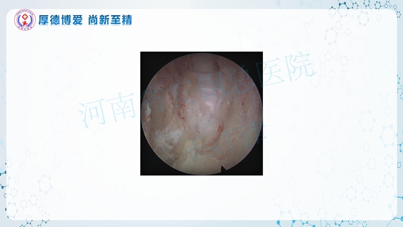 Endo-Assisted-ACDF技术流程与体会_56.jpg