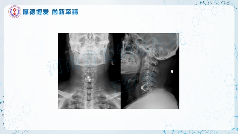 Endo-Assisted-ACDF技术流程与体会_57.jpg
