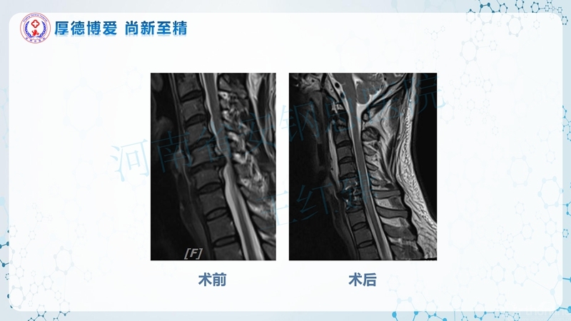Endo-Assisted-ACDF技术流程与体会_58.jpg