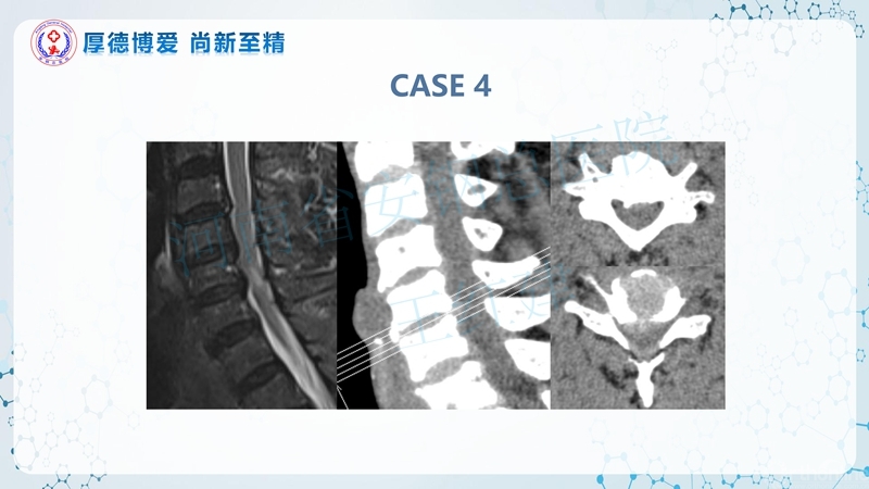 Endo-Assisted-ACDF技术流程与体会_59.jpg
