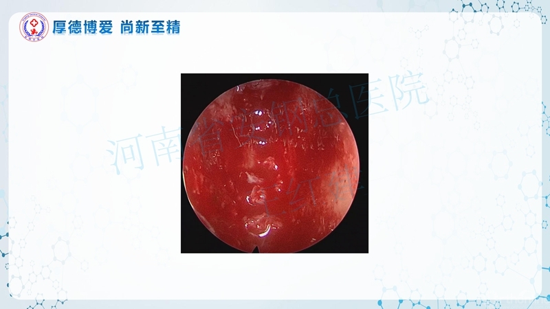 Endo-Assisted-ACDF技术流程与体会_61.jpg