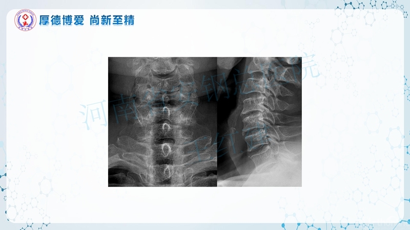 Endo-Assisted-ACDF技术流程与体会_60.jpg
