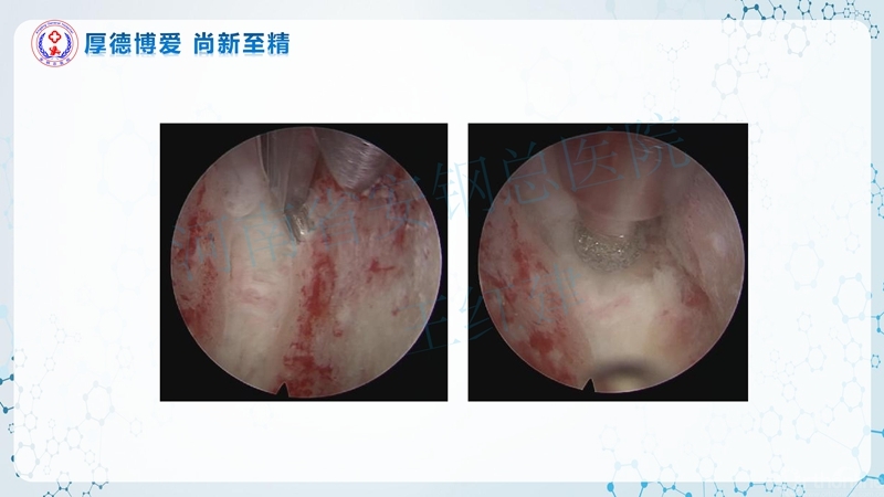 Endo-Assisted-ACDF技术流程与体会_62.jpg