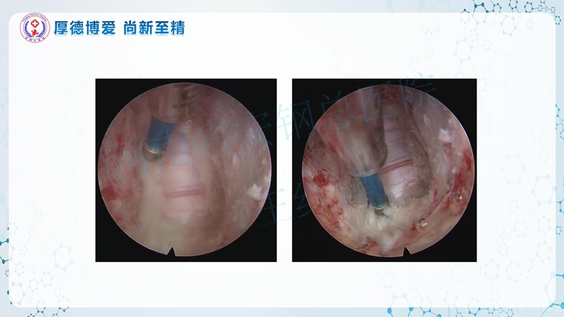 Endo-Assisted-ACDF技术流程与体会_64.jpg