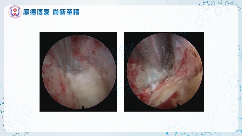 Endo-Assisted-ACDF技术流程与体会_63.jpg