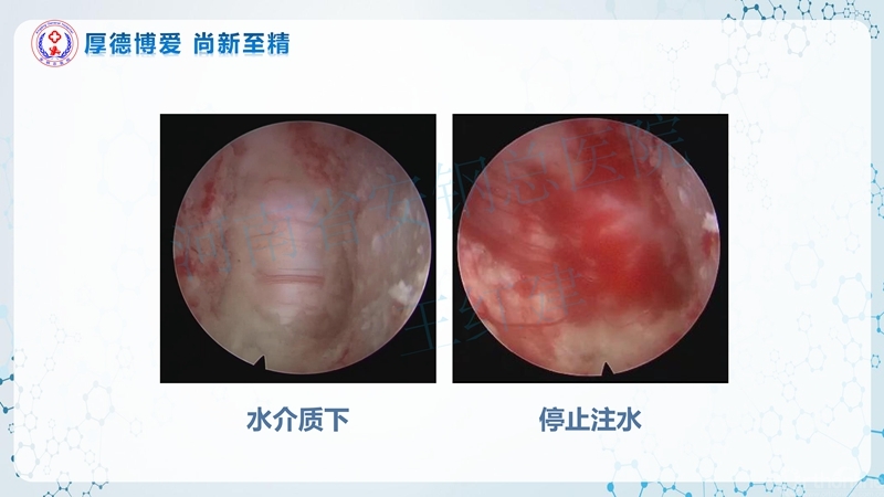 Endo-Assisted-ACDF技术流程与体会_65.jpg