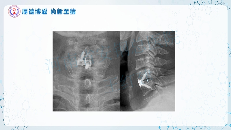 Endo-Assisted-ACDF技术流程与体会_66.jpg
