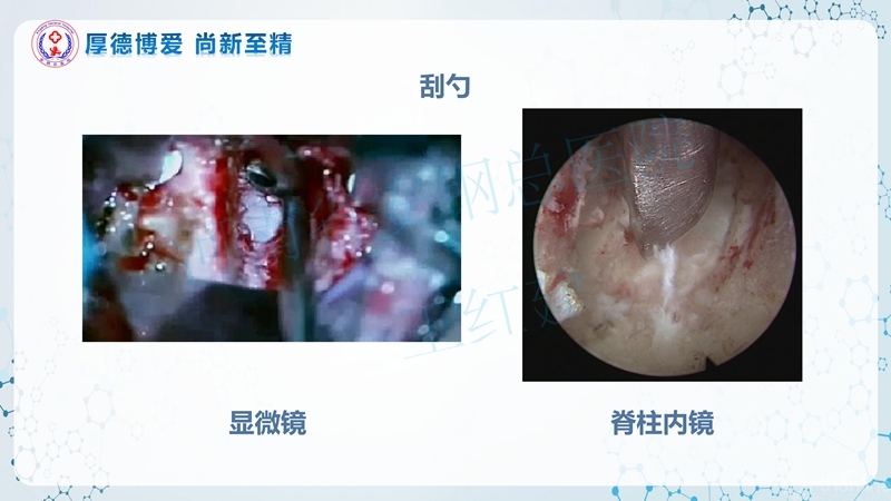 Endo-Assisted-ACDF技术流程与体会_68.jpg