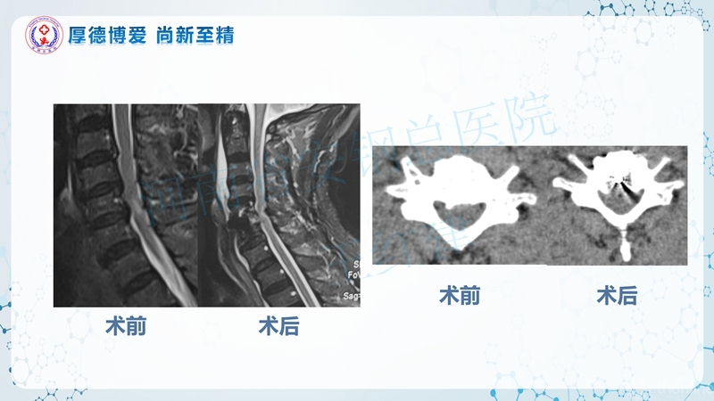 Endo-Assisted-ACDF技术流程与体会_67.jpg
