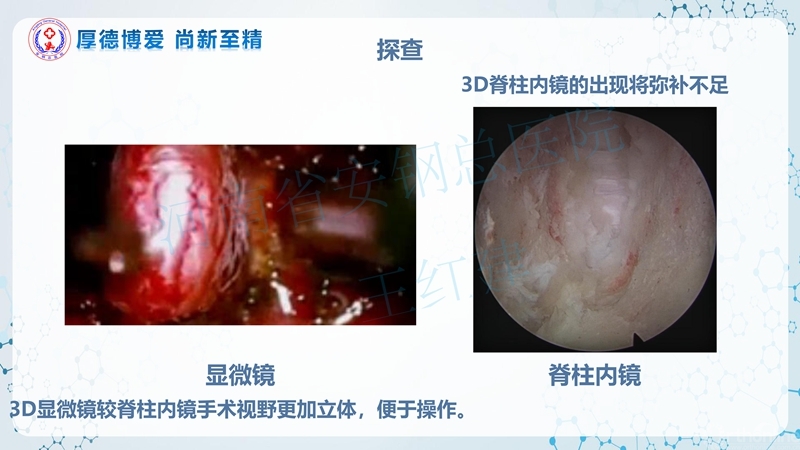 Endo-Assisted-ACDF技术流程与体会_71.jpg