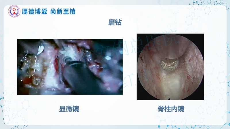 Endo-Assisted-ACDF技术流程与体会_69.jpg