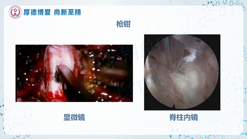 Endo-Assisted-ACDF技术流程与体会_70.jpg