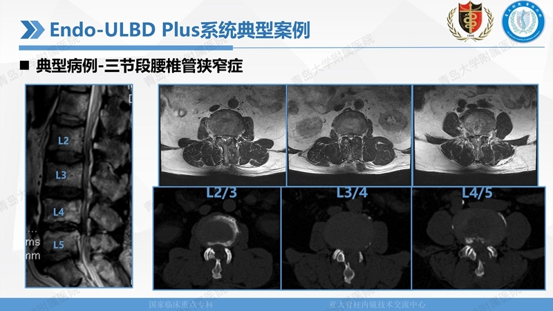 1. ULBD技术体系构建及临床应用 2023.4.5 - 15min_34.jpg
