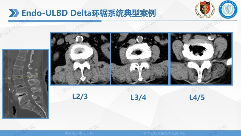 1. ULBD技术体系构建及临床应用 2023.4.5 - 15min_37.jpg