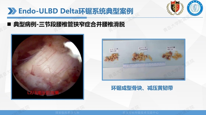 1. ULBD技术体系构建及临床应用 2023.4.5 - 15min_41.jpg