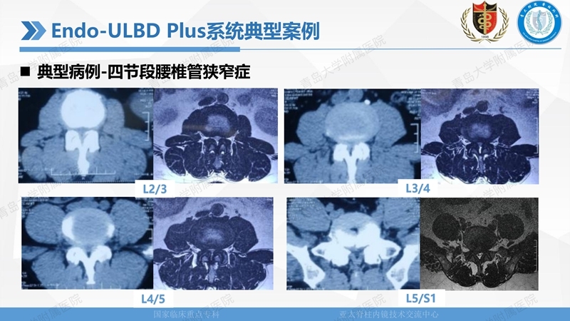 1. ULBD技术体系构建及临床应用 2023.4.5 - 15min_45.jpg