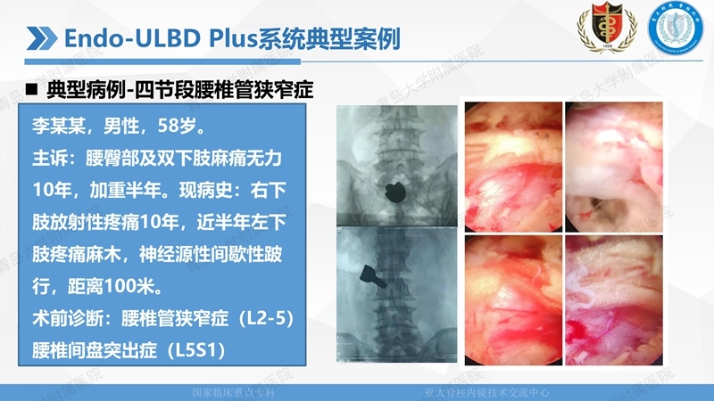 1. ULBD技术体系构建及临床应用 2023.4.5 - 15min_47.jpg