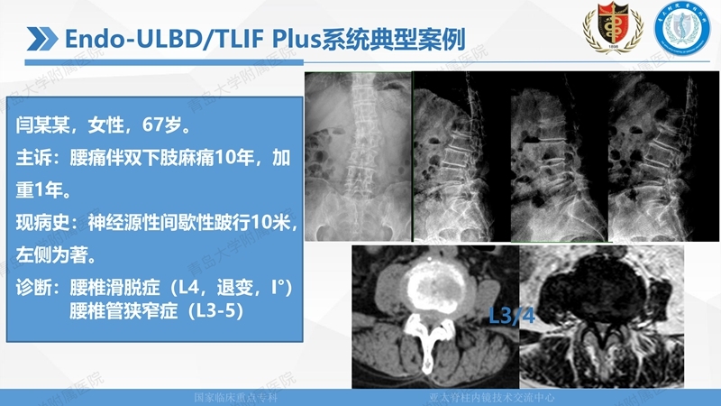 1. ULBD技术体系构建及临床应用 2023.4.5 - 15min_49.jpg
