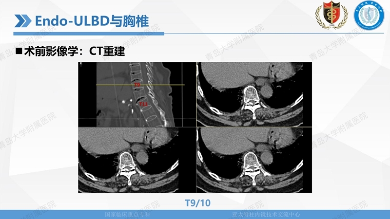 1. ULBD技术体系构建及临床应用 2023.4.5 - 15min_61.jpg