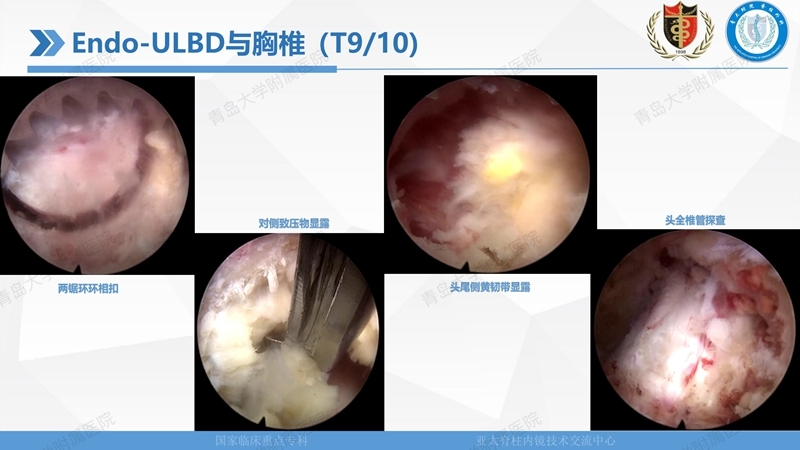 1. ULBD技术体系构建及临床应用 2023.4.5 - 15min_71.jpg