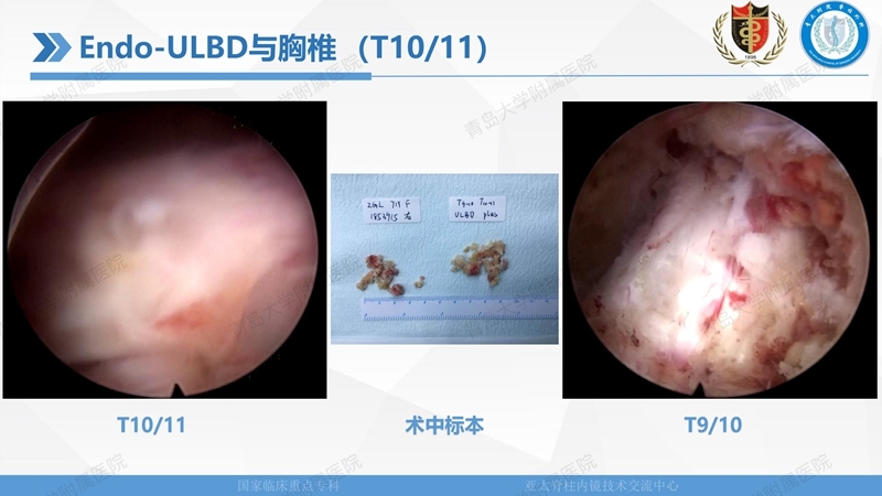 1. ULBD技术体系构建及临床应用 2023.4.5 - 15min_73.jpg