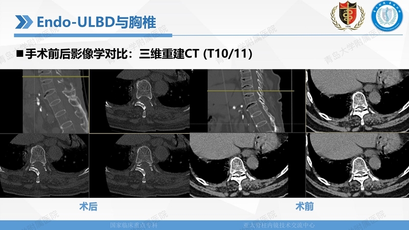 1. ULBD技术体系构建及临床应用 2023.4.5 - 15min_76.jpg