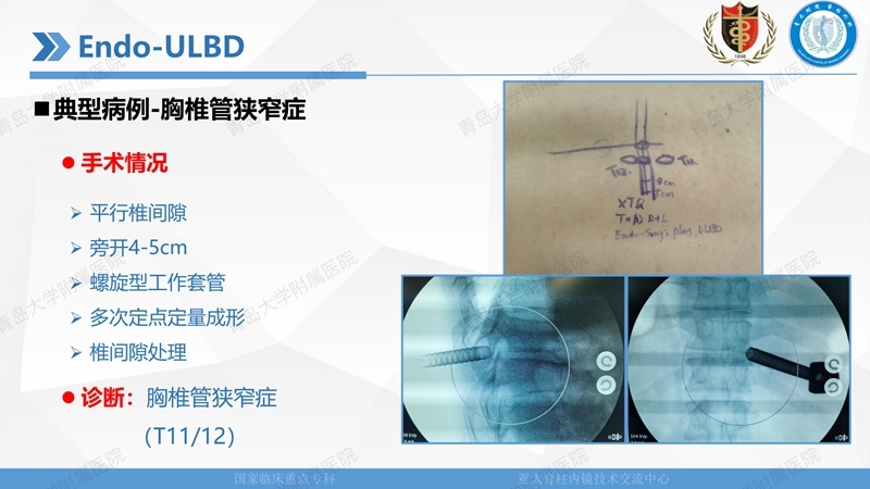 1. ULBD技术体系构建及临床应用 2023.4.5 - 15min_78.jpg