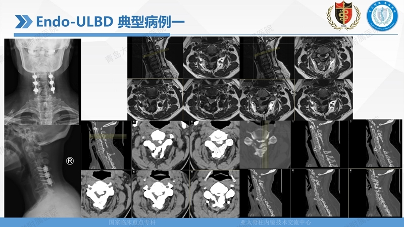 1. ULBD技术体系构建及临床应用 2023.4.5 - 15min_93.jpg