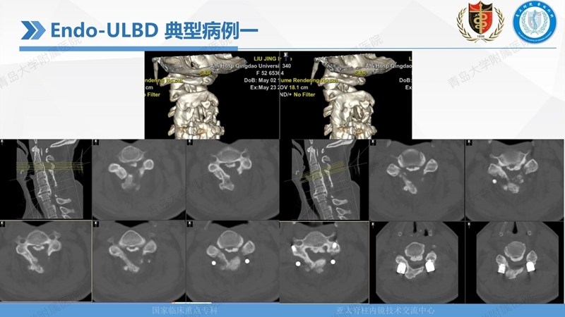 1. ULBD技术体系构建及临床应用 2023.4.5 - 15min_96.jpg