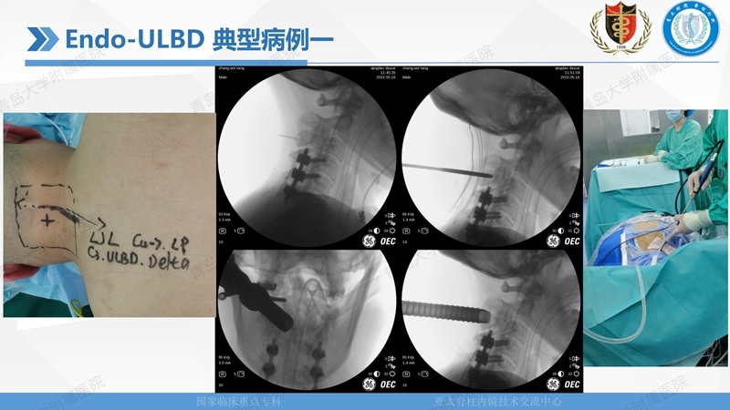 1. ULBD技术体系构建及临床应用 2023.4.5 - 15min_94.jpg