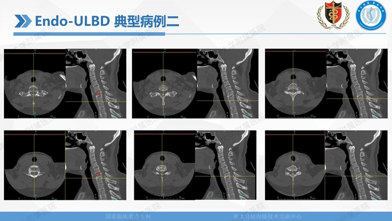 1. ULBD技术体系构建及临床应用 2023.4.5 - 15min_98.jpg