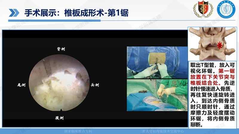 1. ULBD技术体系构建及临床应用 2023.4.5 - 15min_110.jpg