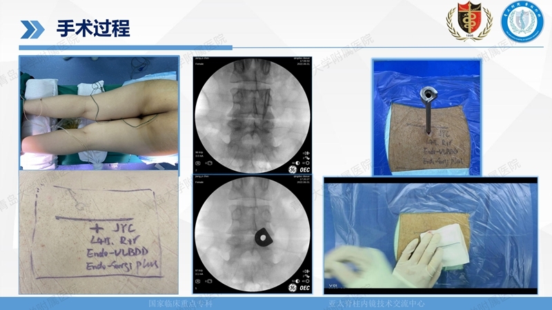 1. ULBD技术体系构建及临床应用 2023.4.5 - 15min_109.jpg