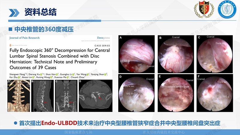 1. ULBD技术体系构建及临床应用 2023.4.5 - 15min_119.jpg