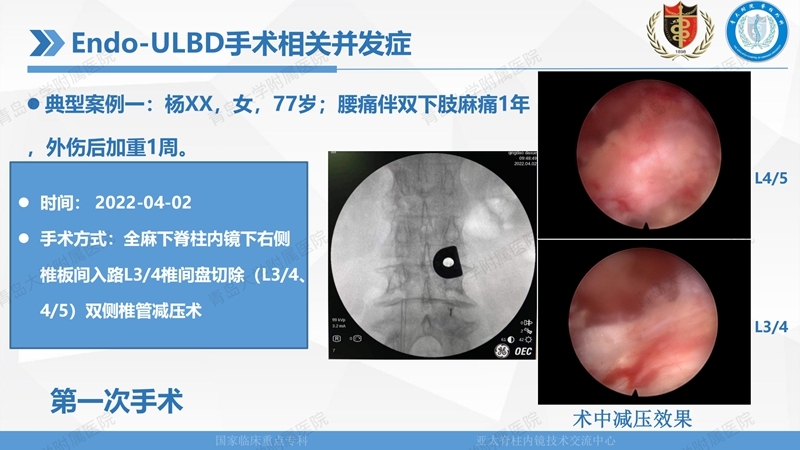 1. ULBD技术体系构建及临床应用 2023.4.5 - 15min_127.jpg