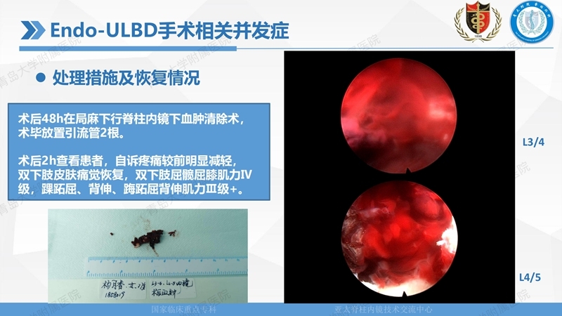 1. ULBD技术体系构建及临床应用 2023.4.5 - 15min_129.jpg