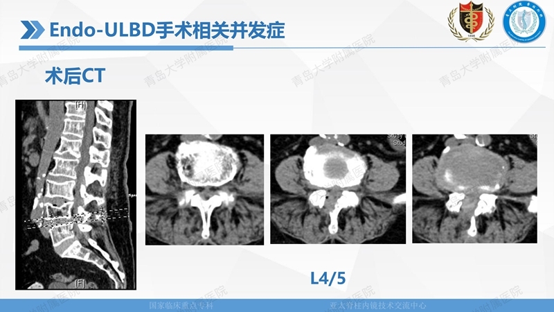 1. ULBD技术体系构建及临床应用 2023.4.5 - 15min_132.jpg