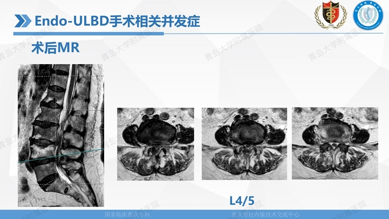 1. ULBD技术体系构建及临床应用 2023.4.5 - 15min_134.jpg